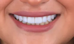 Depois - Dentes Amarelados